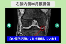右半月板損傷　幹細胞治療