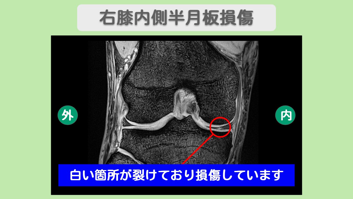 右半月板損傷 幹細胞治療