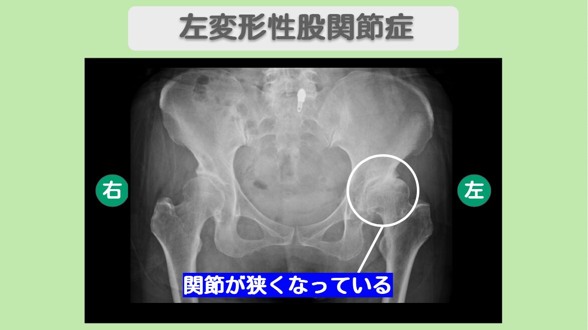 左変形性股関節症