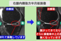 右膝内側後方半月板損傷