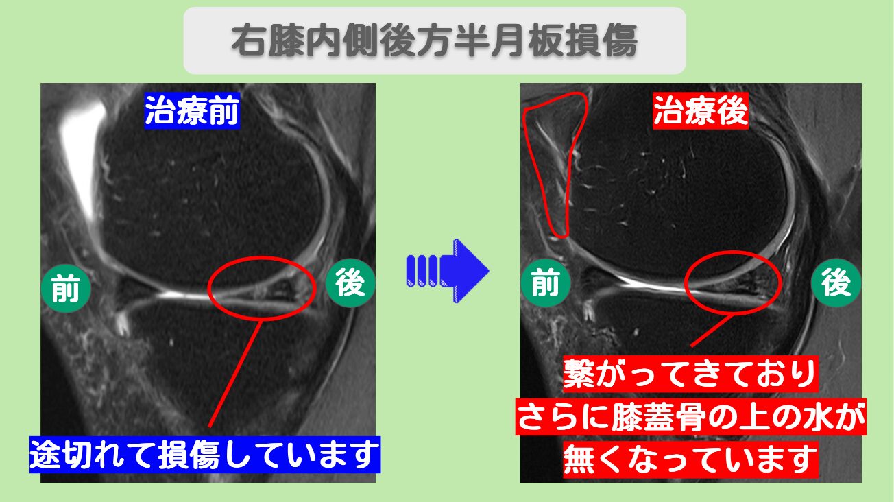 右膝内側後方半月板損傷