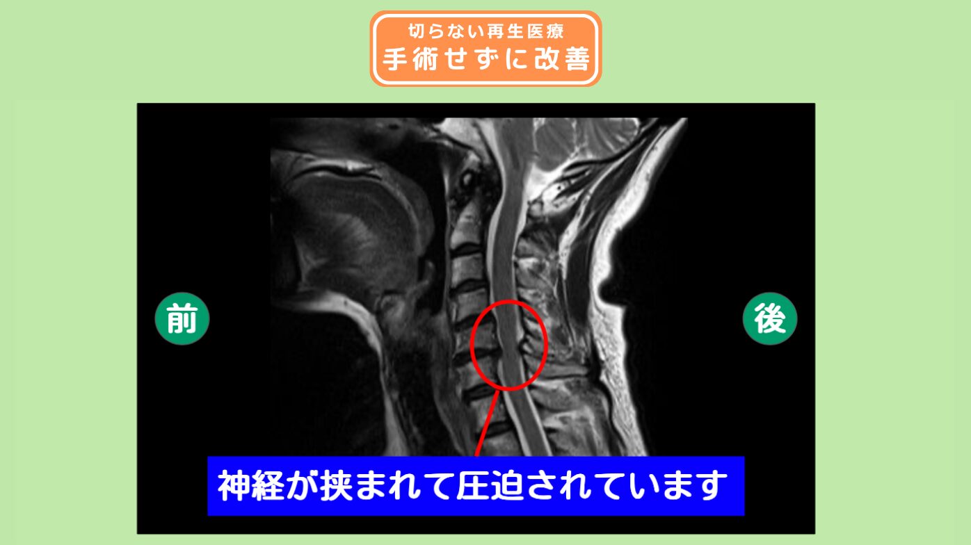 頸椎症性脊髄症