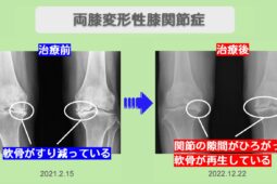 両変形性膝関節症ビフォー アフター