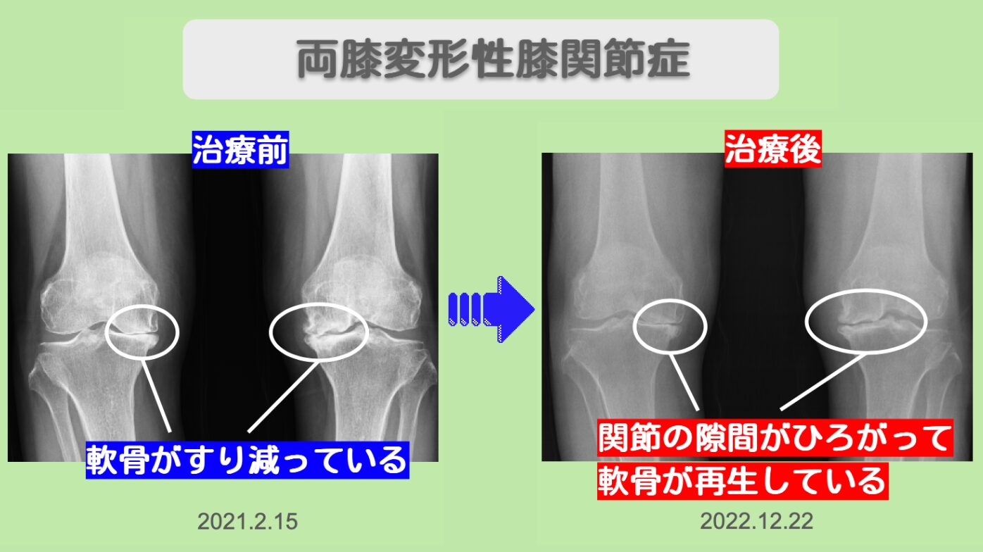 両変形性膝関節症ビフォー アフター