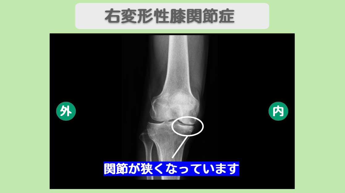 変形性膝関節症
