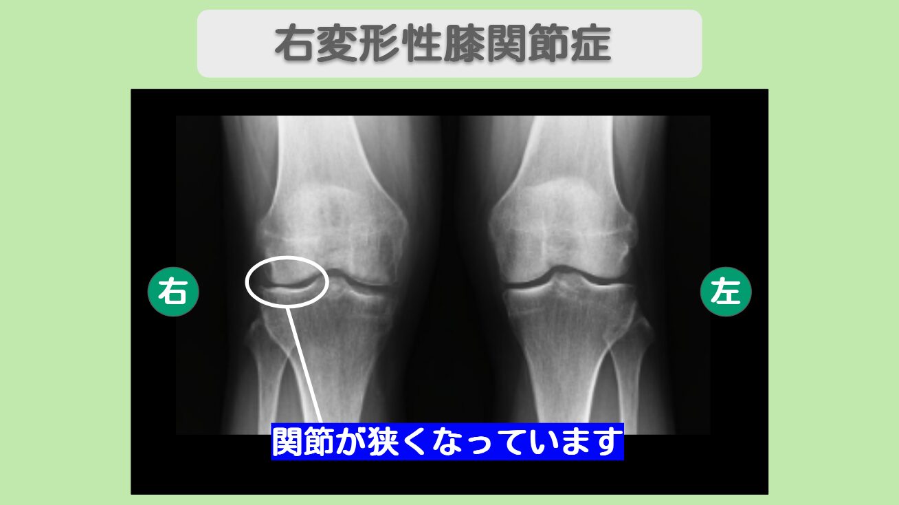 変形性膝関節症