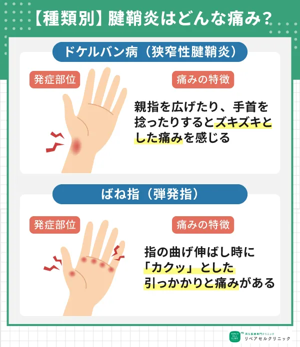 腱鞘炎の種類と痛みの特徴