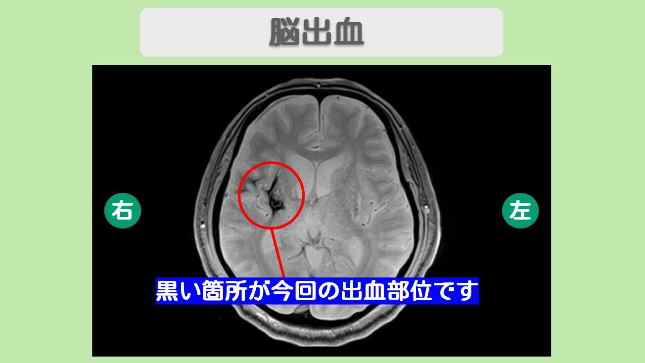 脳出血