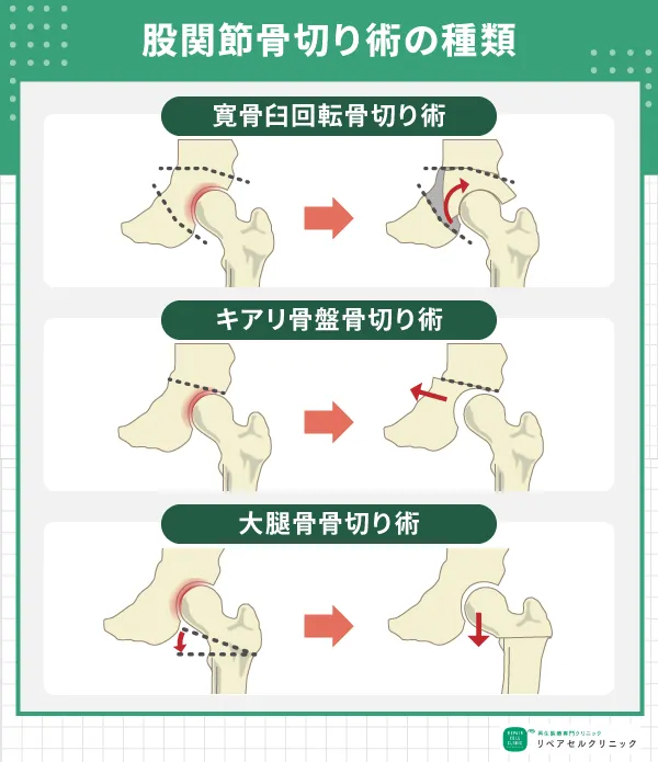 股関節骨切り術の種類