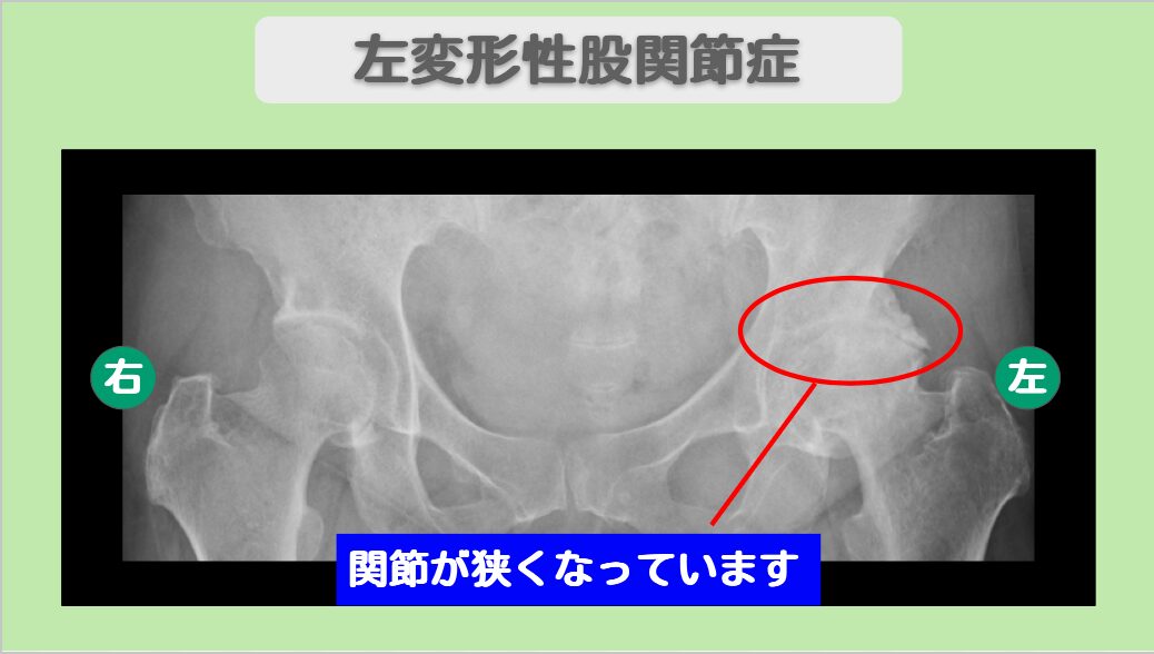 変形性股関節症