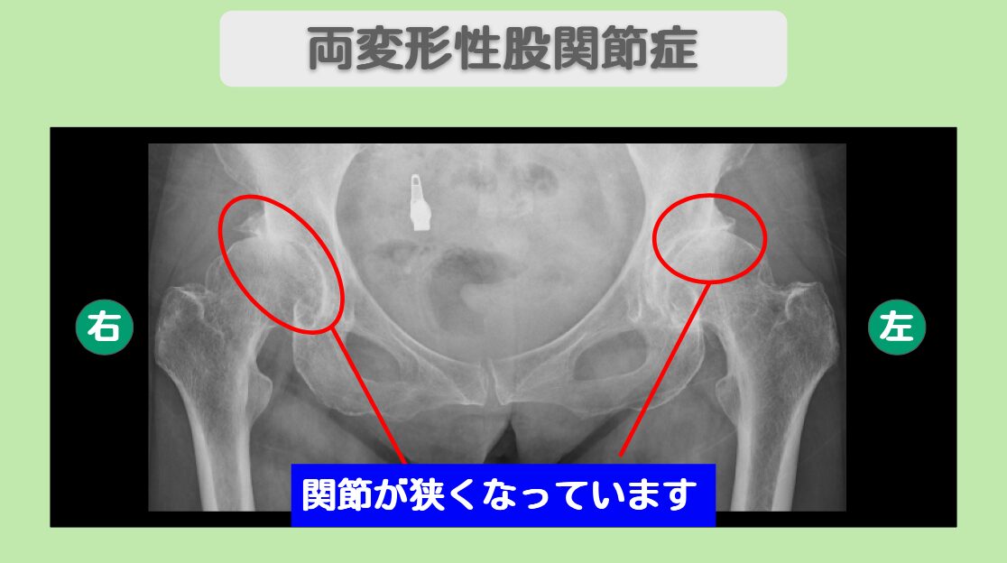 変形性股関節症