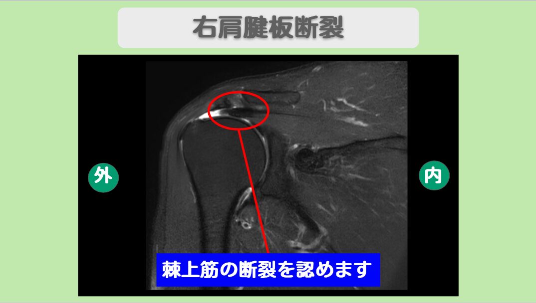 右肩腱板損傷