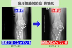 変形性膝関節症・骨壊死