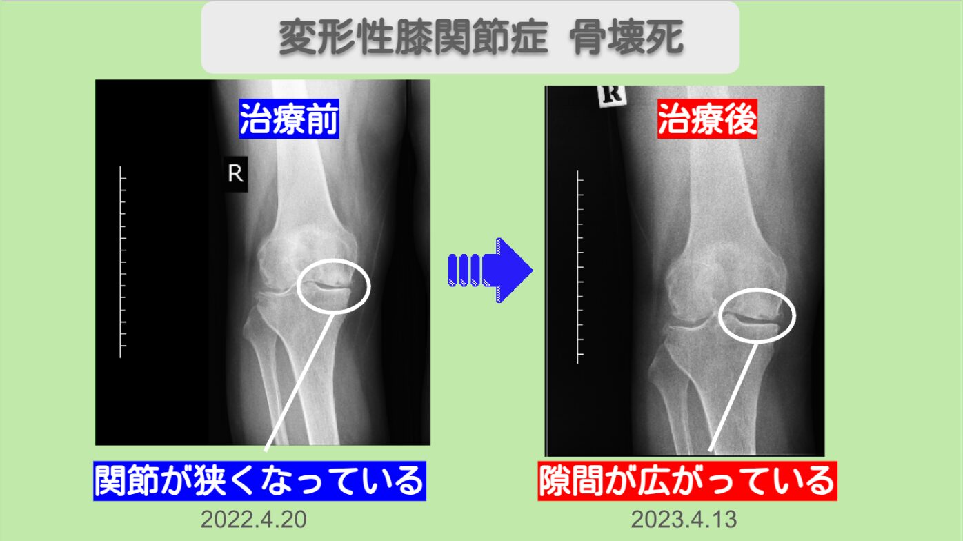 変形性膝関節症・骨壊死