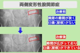 変形性股関節症