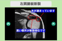 肩腱板損傷