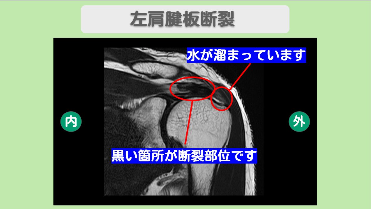 肩腱板損傷
