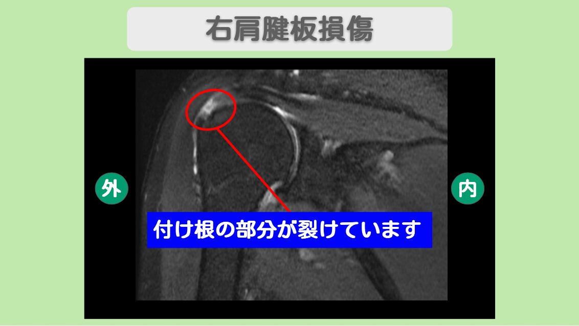肩腱板損傷