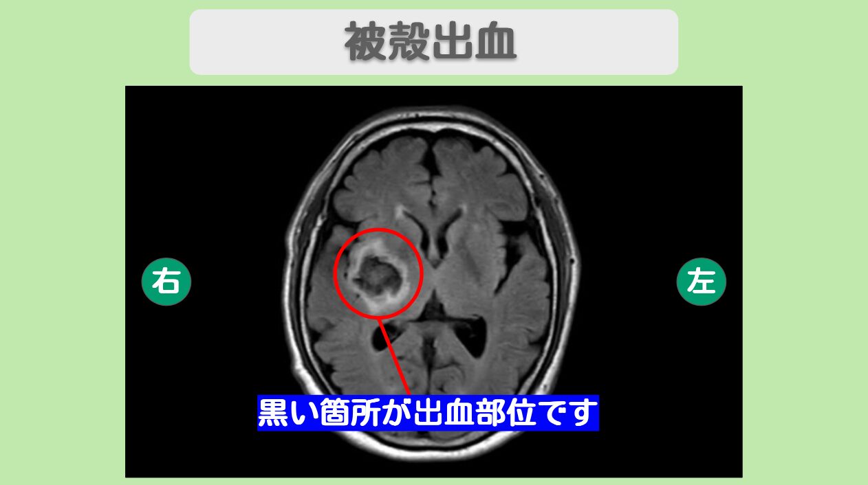 脳出血
