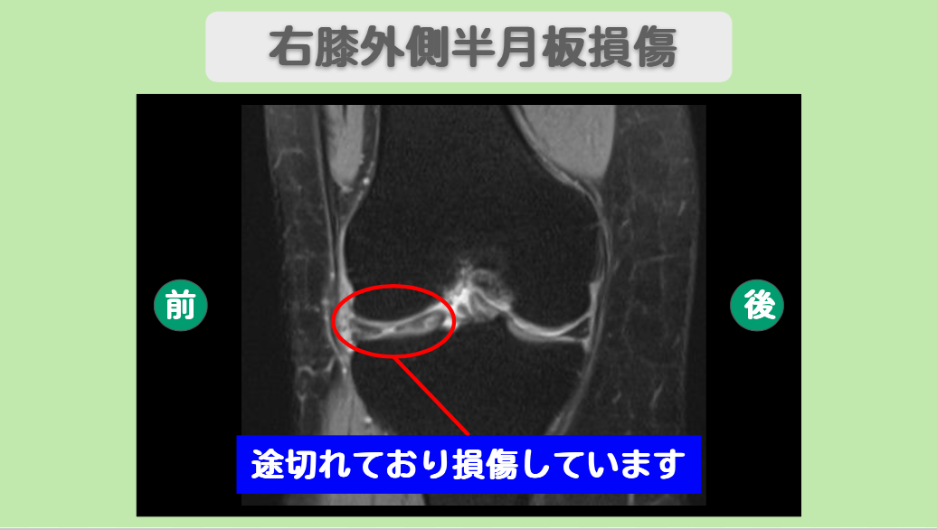 半月板損傷