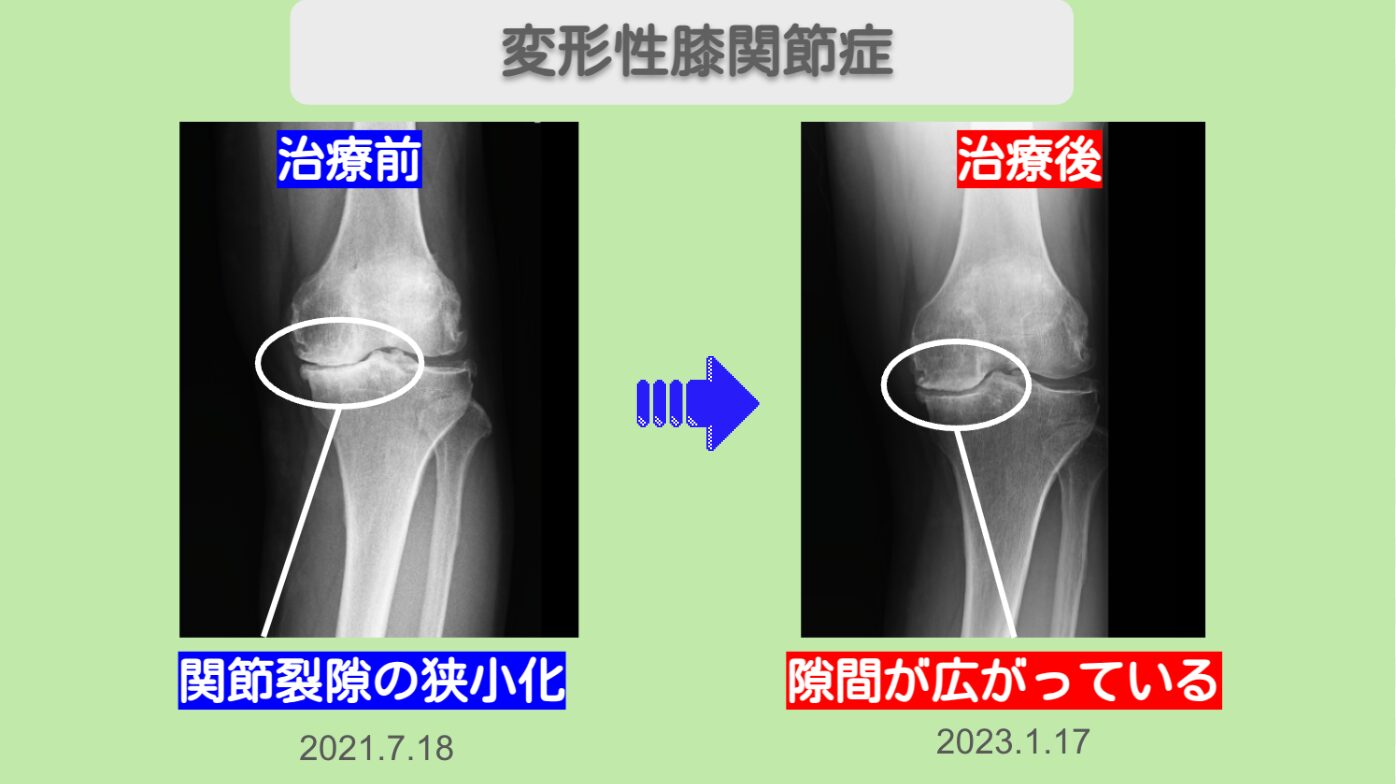 変形性膝関節症