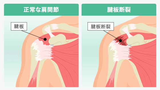 腱板損傷