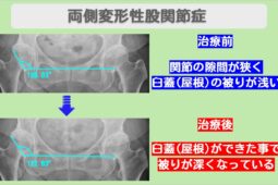 変形性股関節症
