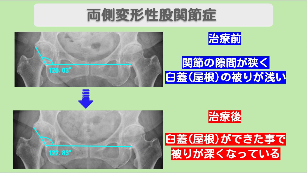 変形性股関節症