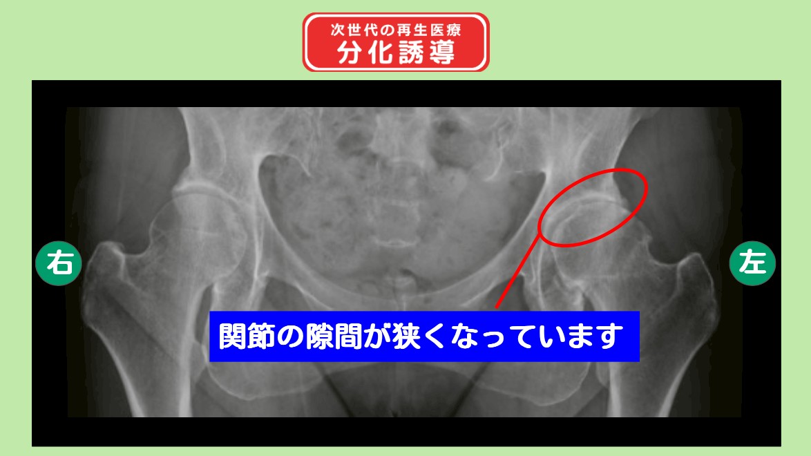 変形性股関節症
