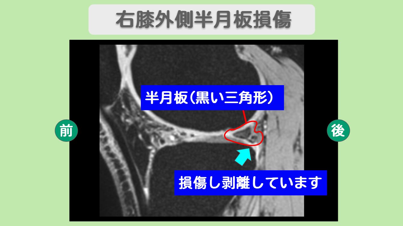半月板損傷
