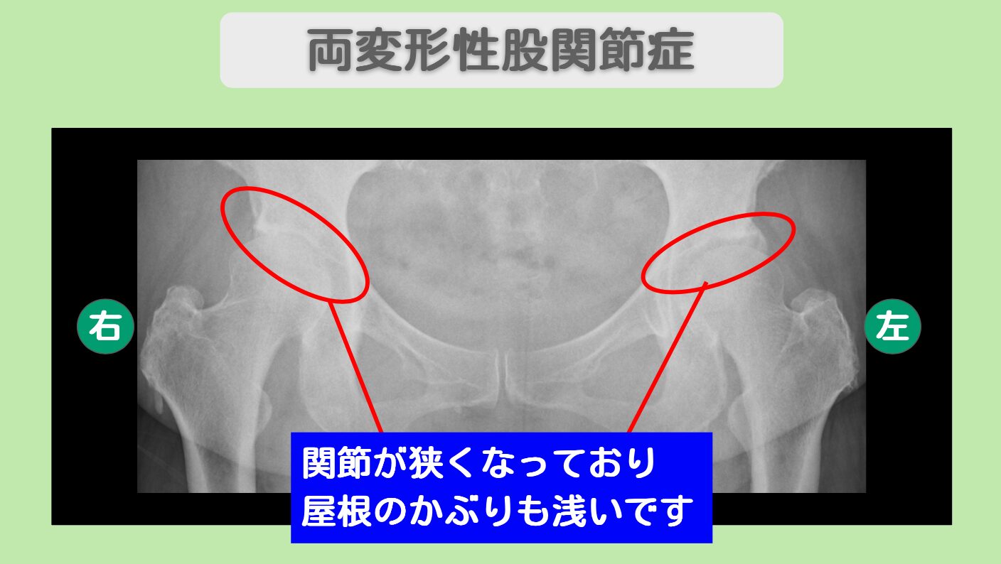 変形性股関節症