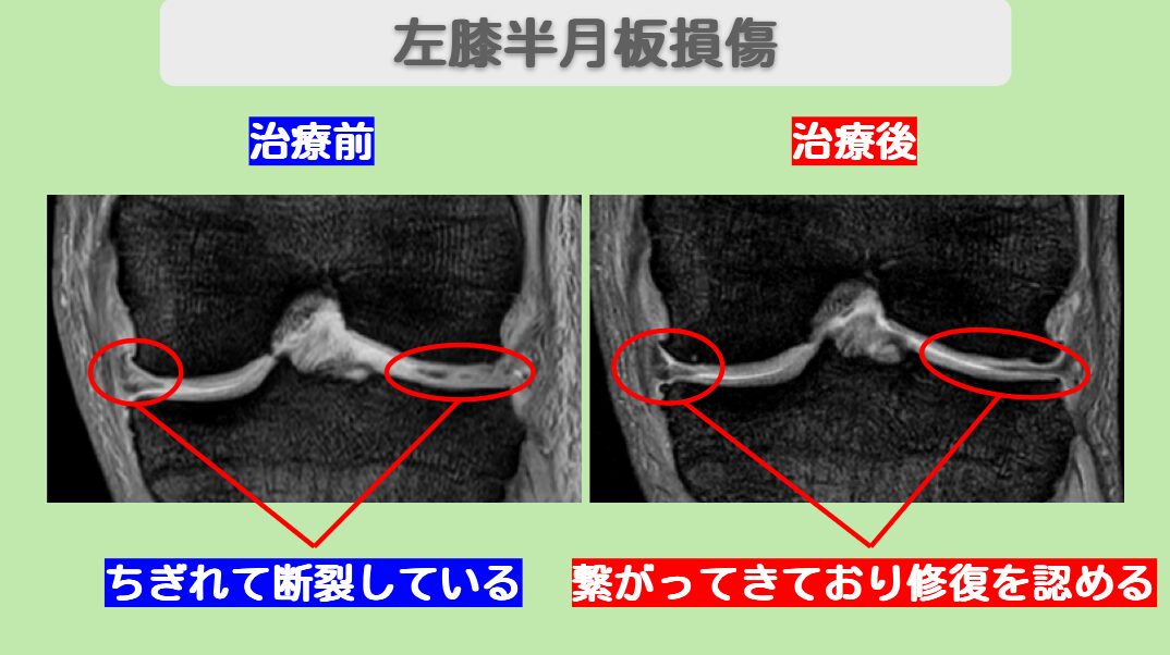半月板損傷