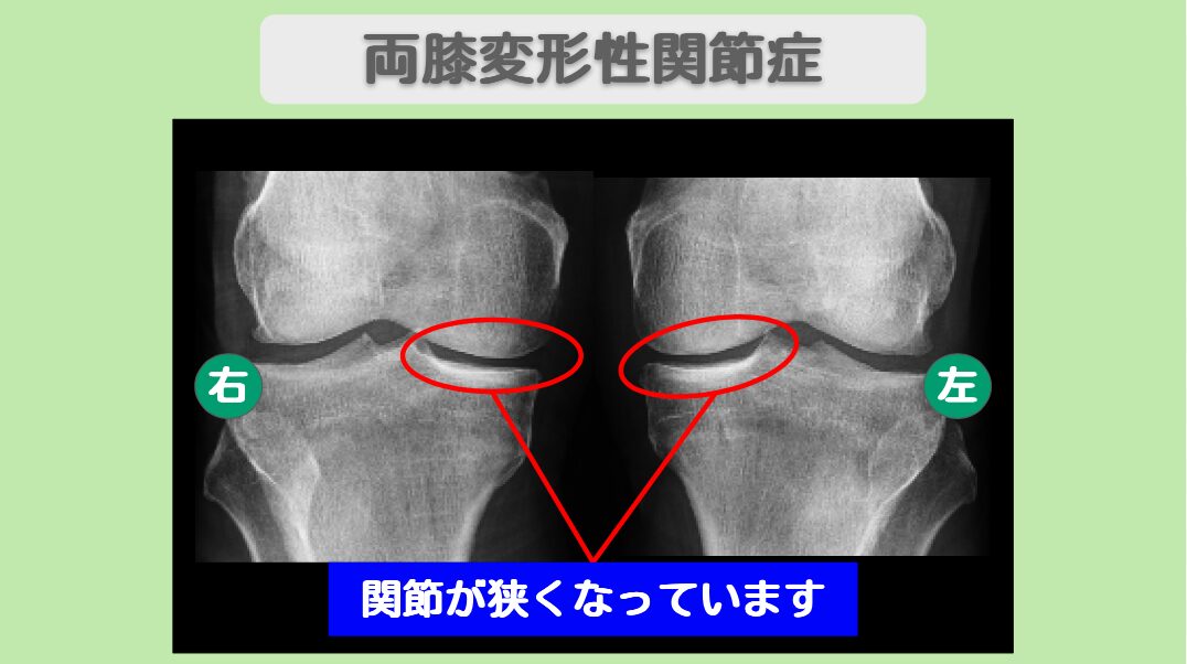 変形性膝関節症