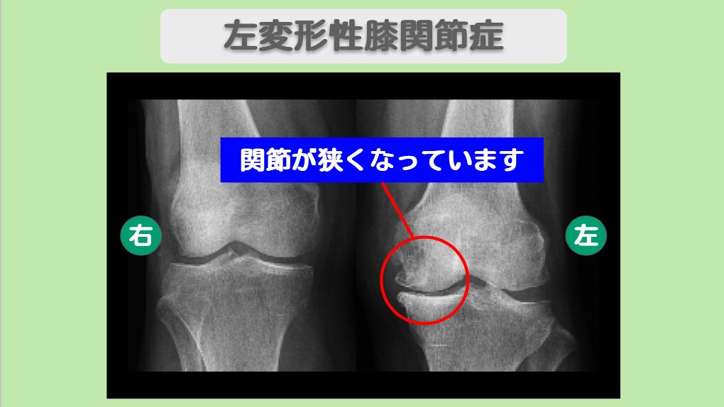 変形性膝関節症
