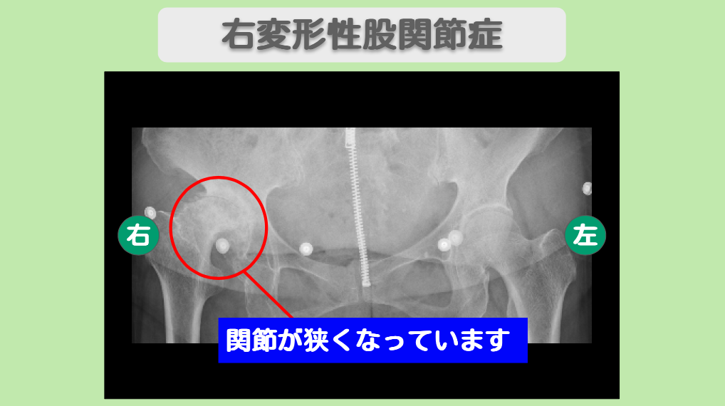 変形性股関節症