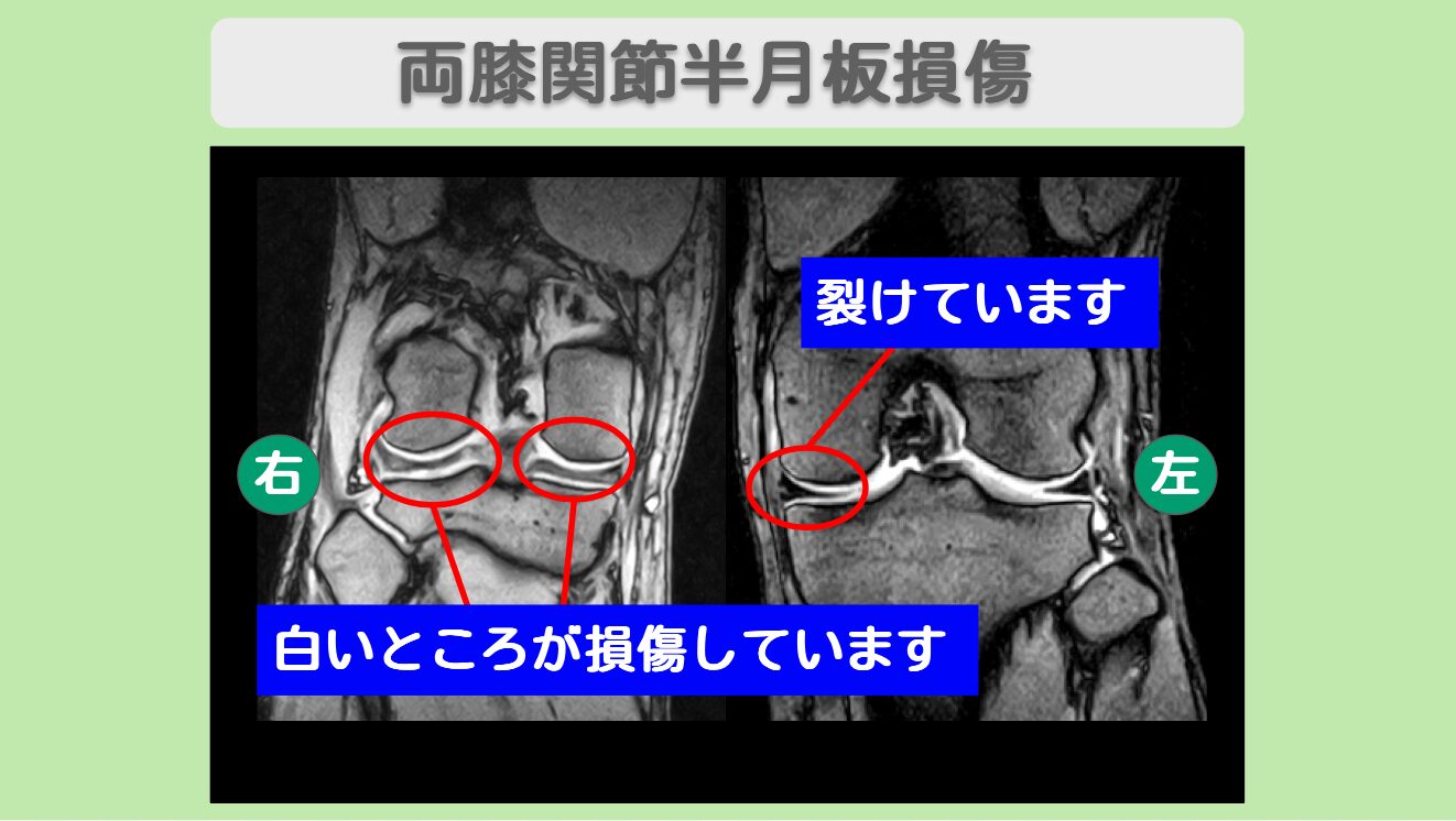 半月板損傷