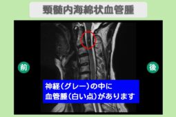 頸髄内海綿状血管腫