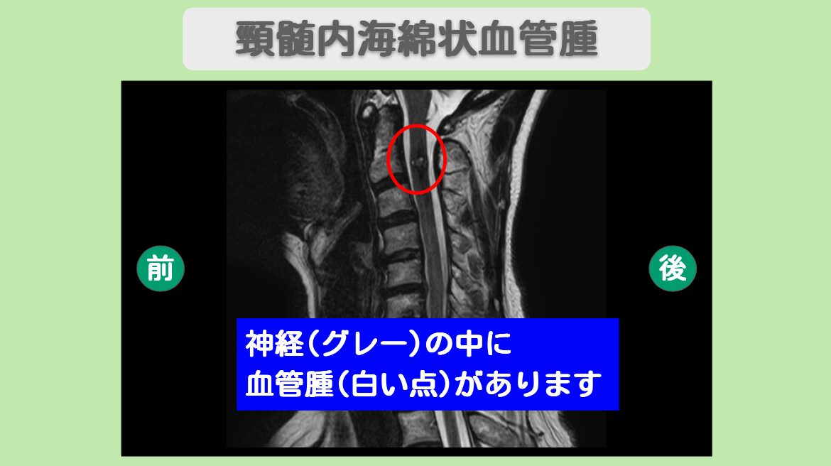 頸髄内海綿状血管腫