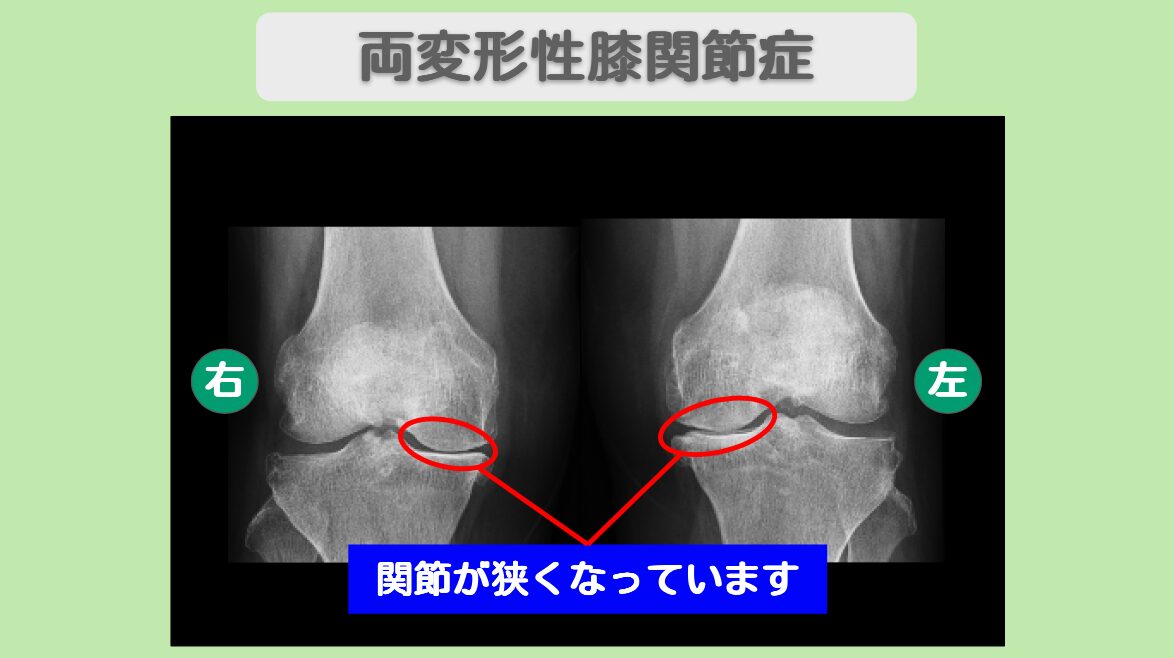 両変形性膝関節症