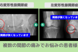 変形性膝関節症、変形性股関節症