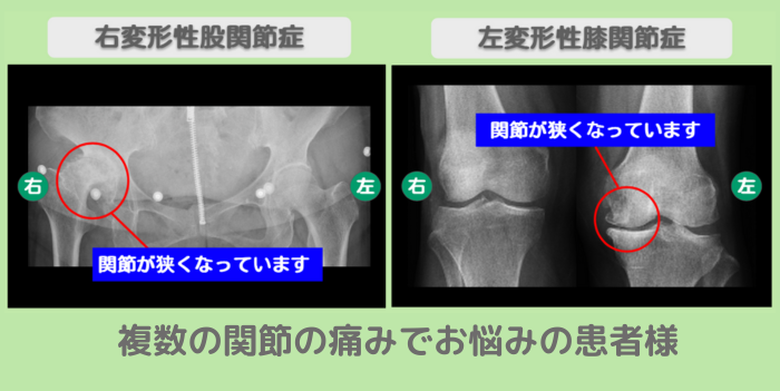 変形性膝関節症、変形性股関節症