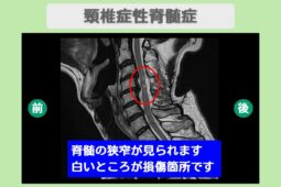 頚髄症性脊髄症