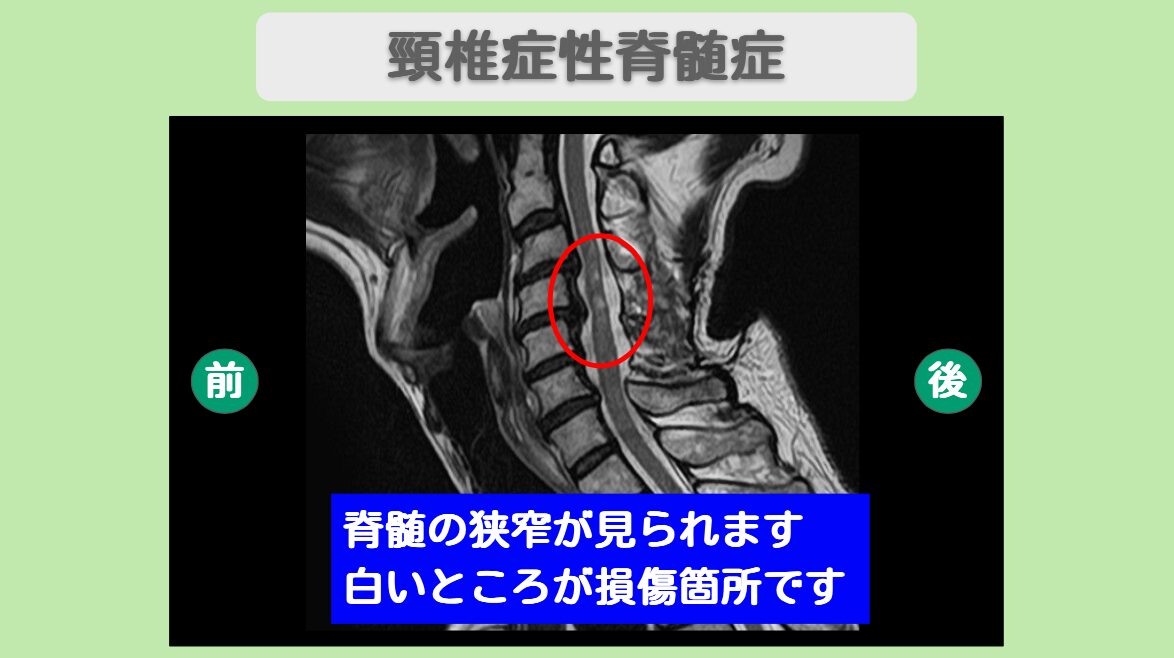 頚髄症性脊髄症