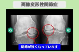 変形性膝関節症