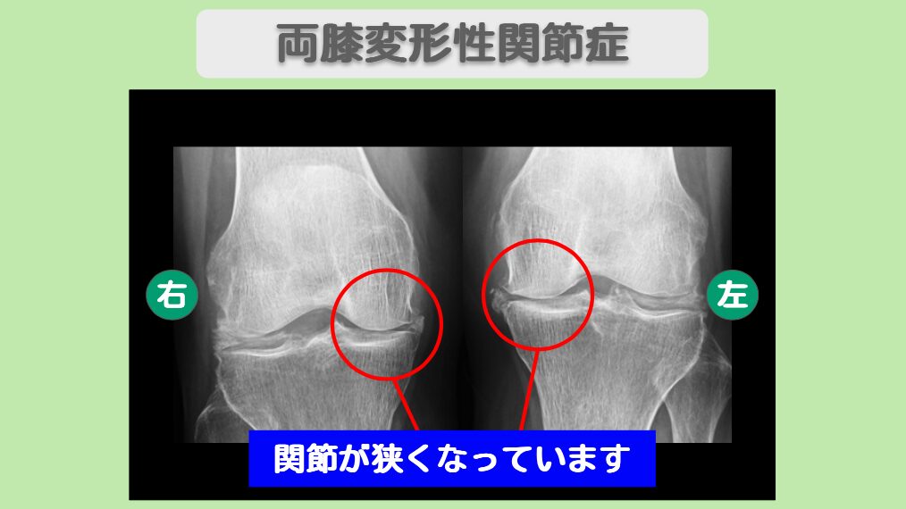 変形性膝関節症