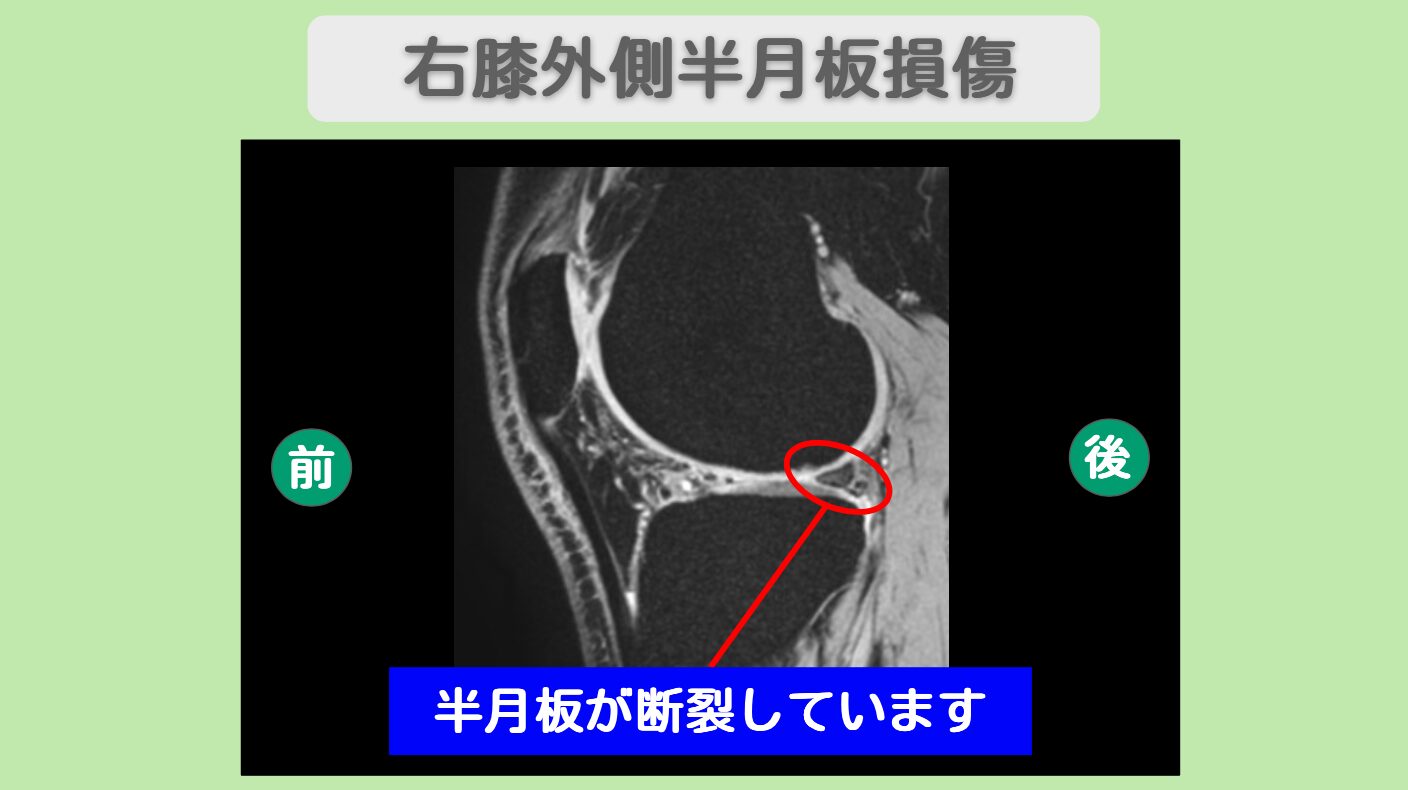 半月板損傷　