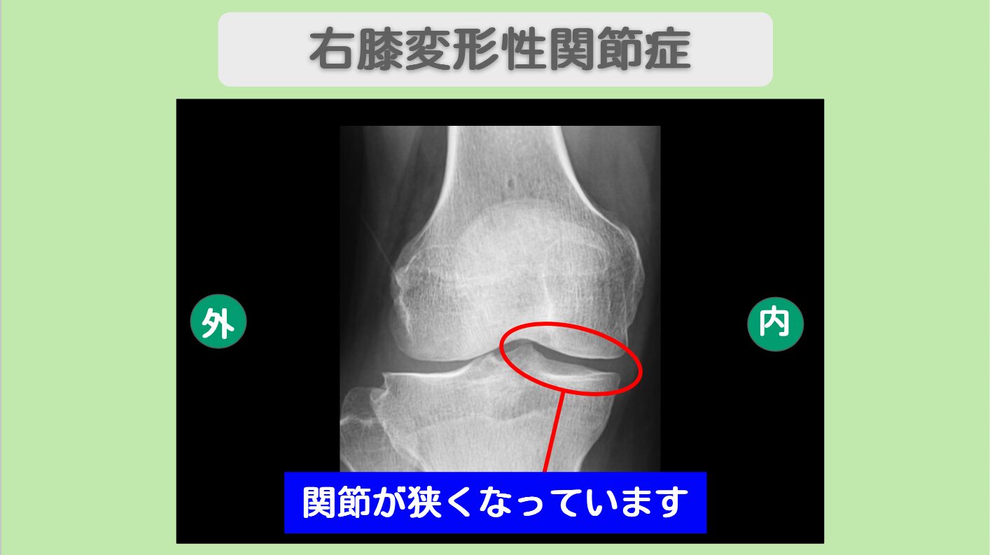 変形性膝関節症