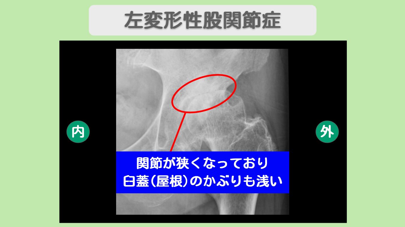 変形性股関節症