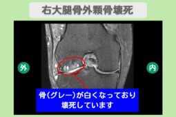 大腿骨外顆骨壊死