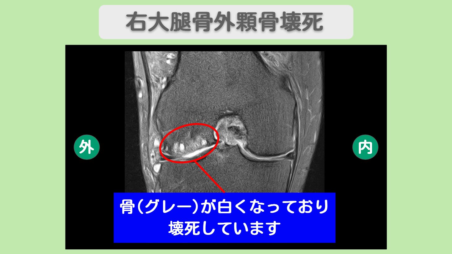 大腿骨外顆骨壊死